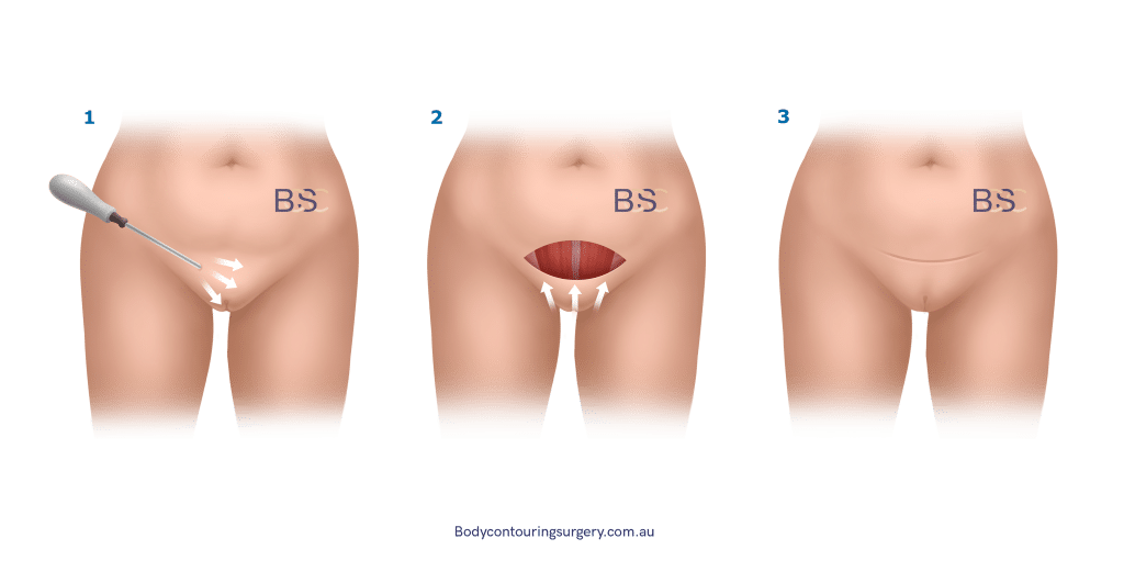 Monsplasty surgical technique