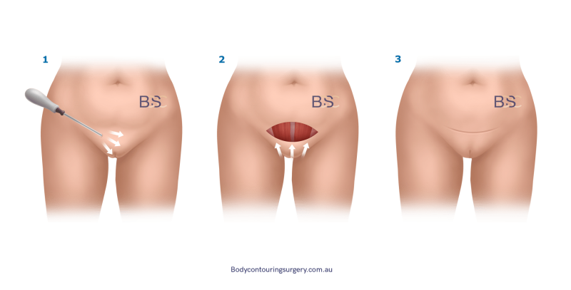 Monsplasty surgical technique
