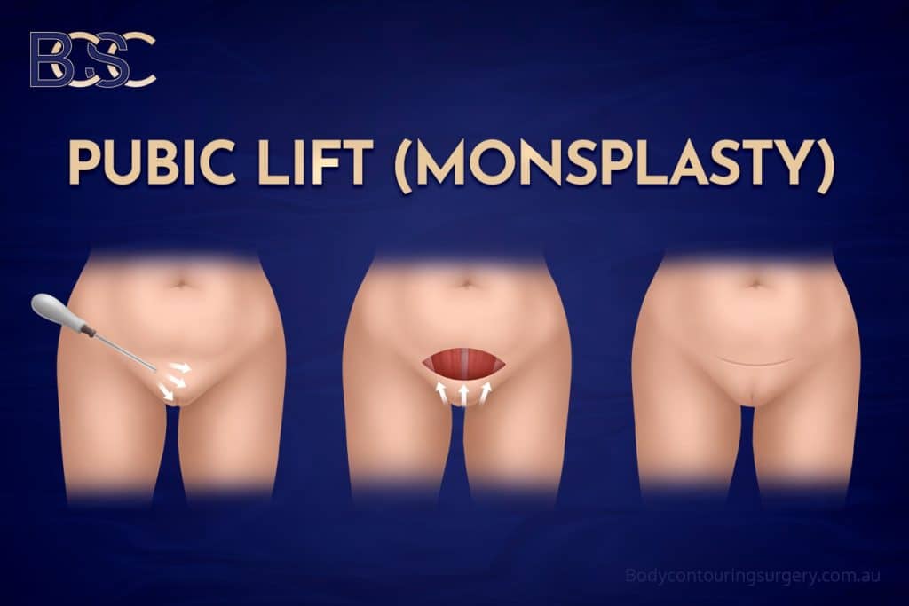 Pubic Lift (Monsplasty)
