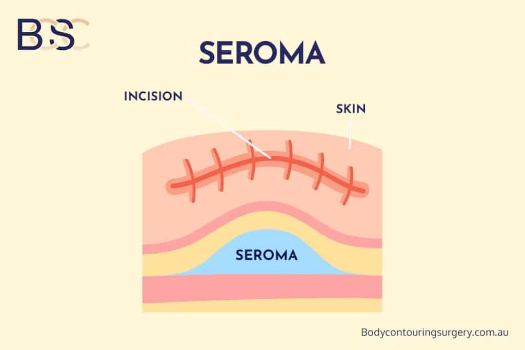 Seroma Formation
