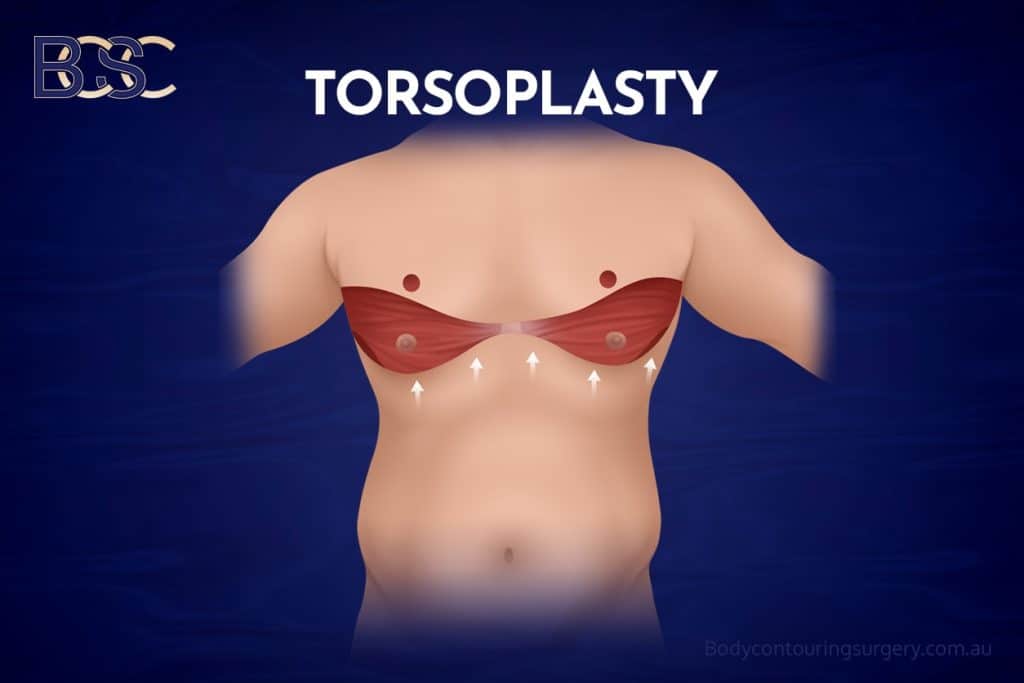Torsoplasty