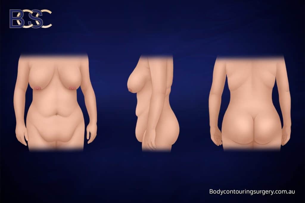 Why Do Patients Consider Monsplasty