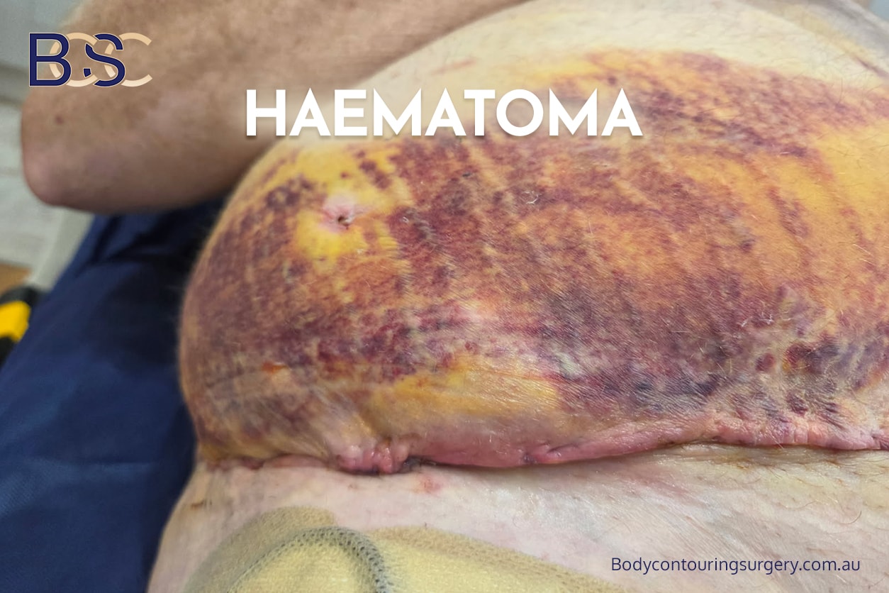 Haematoma Haematoma