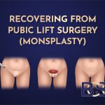 Recovering from Pubic Lift Surgery (Monsplasty)