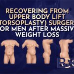 Recovering From Upper Torsoplasty (Body Lift) Surgery for Men After Massive Weight Loss