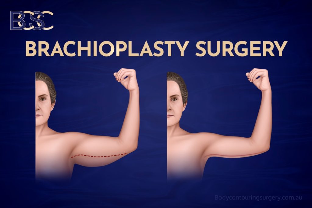 Brachioplasty Surgery