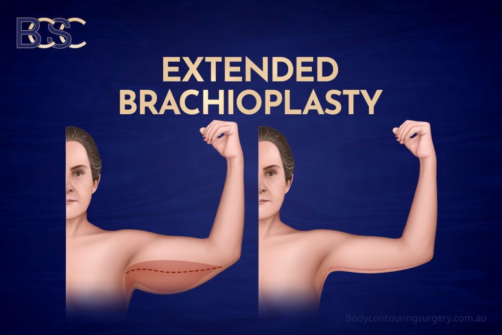 Extended Brachioplasty