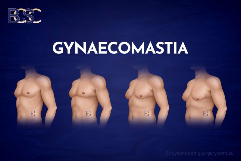 Gynaecomastia - BCSC