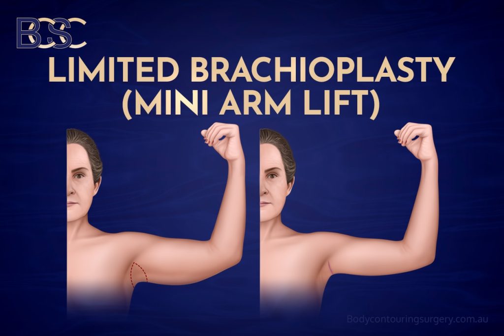 Limited Brachioplasty (also referred to as mini arm lift)