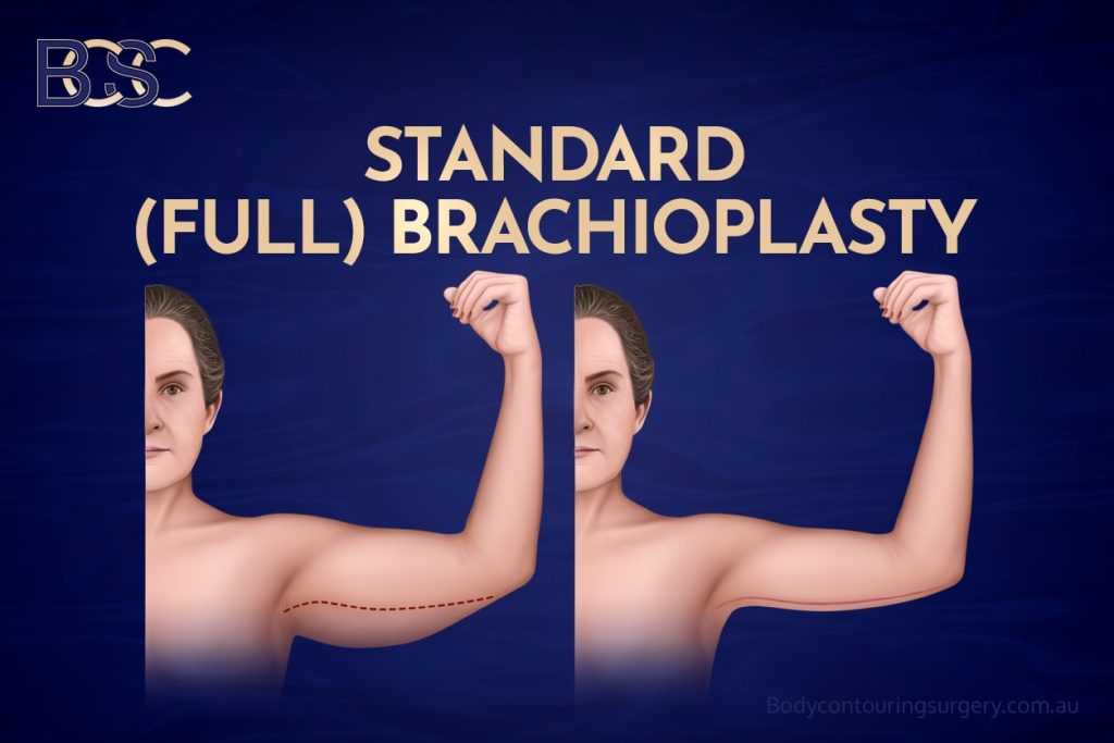 Standard (Full) Brachioplasty