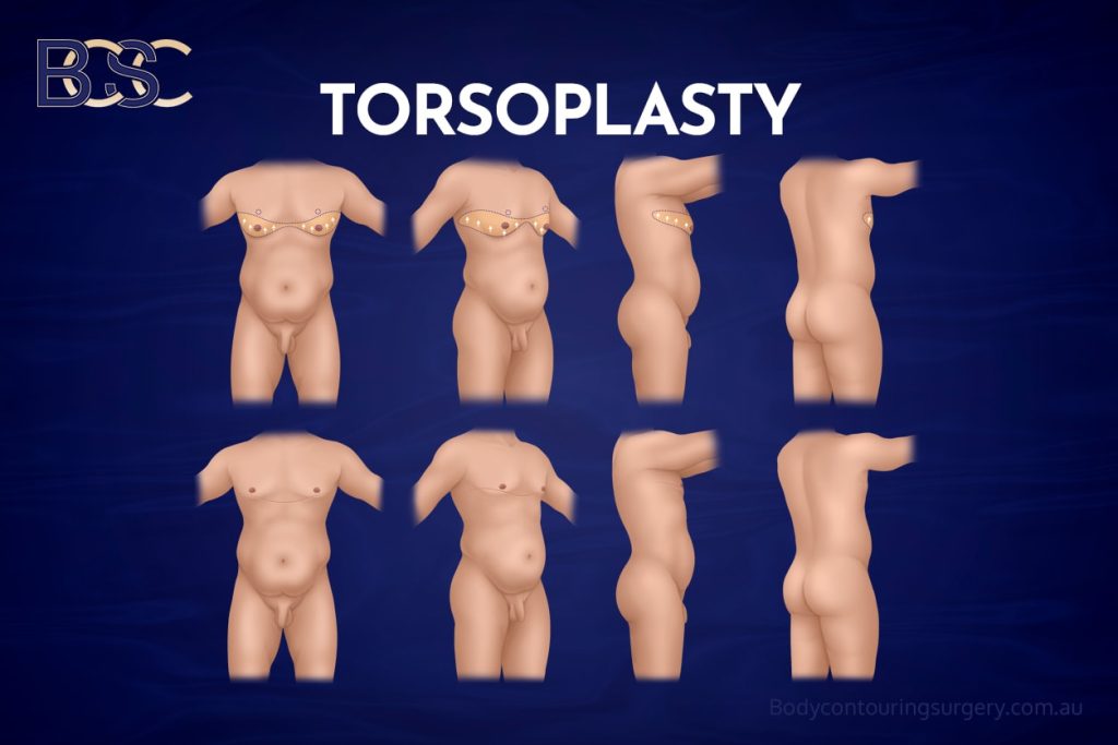 Upper Body Lift (Torsoplasty) Surgery for Men After Massive Weight Loss