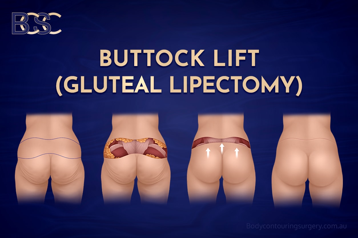 Gluteal lipectomy