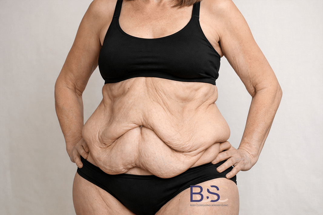Post Weight Loss - Excess Skin